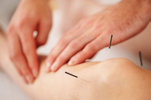 Acupuncture