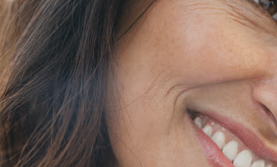 DYSPORT® Cosmetic Wrinkle Treatment - Crow's Feet